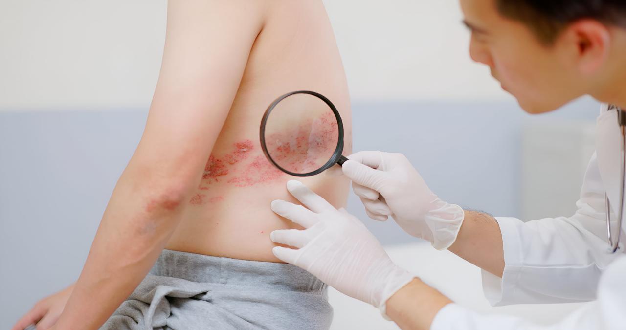kolaborasi-lintas-sektor-tingkatkan-pencegahan-cacar-api-ke-tindakan-preventif-nyata